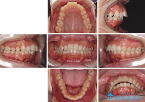 口がしっかりと閉じられない ワイヤー装置での抜歯矯正で出っ歯を改善の治療前