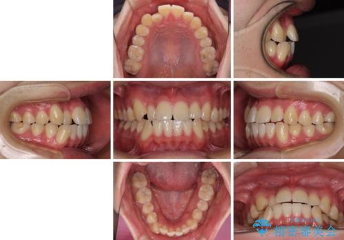 八重歯と前歯のクロスバイト ワイヤー装置で短期間矯正の治療前