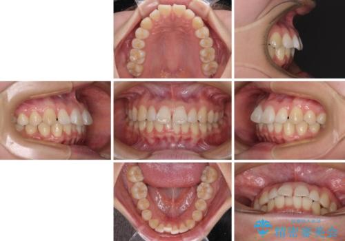 【モニター】すきっ歯をインビザラインで解消の治療前