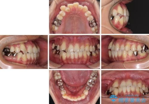 前歯のクロスバイトを改善　インビザライン矯正の治療前