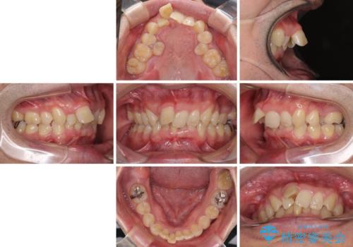 前歯が折れたついでに歯並びも改善 矯正治療と前歯のセラミック治療の治療前