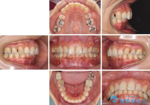 抜歯矯正の後戻りでできたスペース インビザライン矯正とセラミック治療の治療前