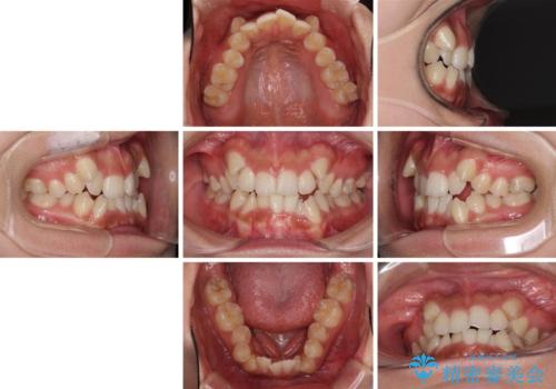 著しい八重歯が気になる インビザラインでの矯正治療の治療前