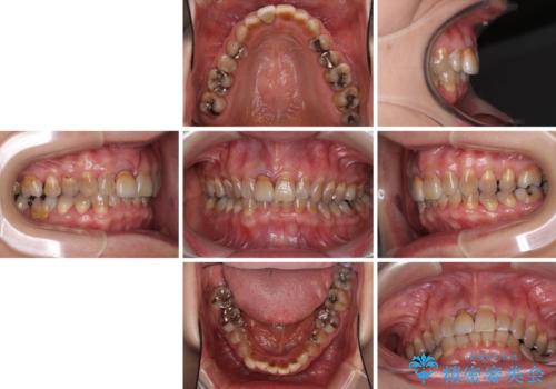 咬み合わせを治したい インビザラインによる矯正治療の治療前