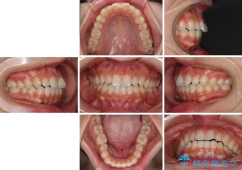 インビザラインを用いた上顎の部分矯正の治療前