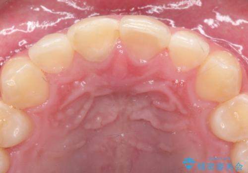 【ホワイトニング】右上前歯の歯茎の辺りが暗いのが気になる。の治療後