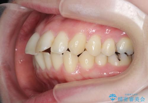 [ インビザライン矯正 ] 出っ歯をマウスピースで治したいの治療前
