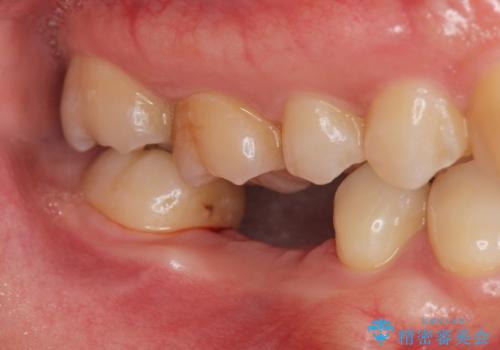 放置した虫歯 インプラントによる機能回復の治療中