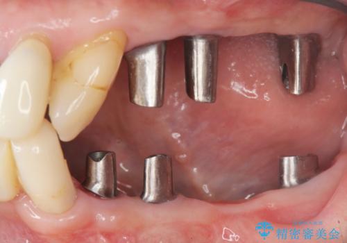 [ 歯周病による多数歯の欠損 ]   全顎的インプラント・歯周病治療の治療中