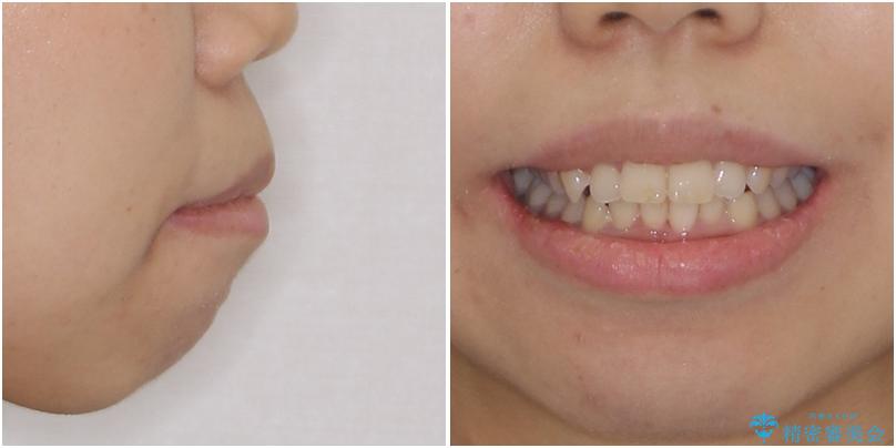 口がしっかりと閉じられない　ワイヤー装置での抜歯矯正で出っ歯を改善の治療前（顔貌）