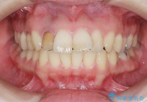 [ インビザライン矯正 ] 出っ歯をマウスピースで治したいの症例 治療前