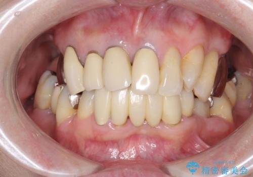 [ 歯周病による多数歯の欠損 ]   全顎的インプラント・歯周病治療の症例 治療前