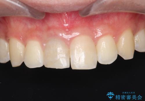 【ホワイトニング】右上前歯の歯茎の辺りが暗いのが気になる。の治療前