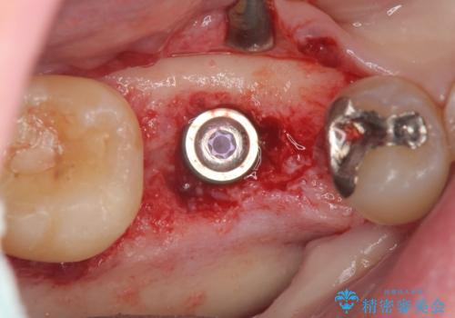 放置した虫歯　インプラントによる機能回復の治療中