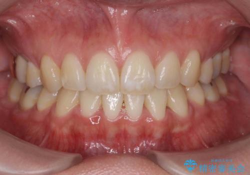 真ん中が右にずれている　前歯のがたつき　治療途中に地方へ引っ越したが、通ってワイヤー矯正の症例 治療後