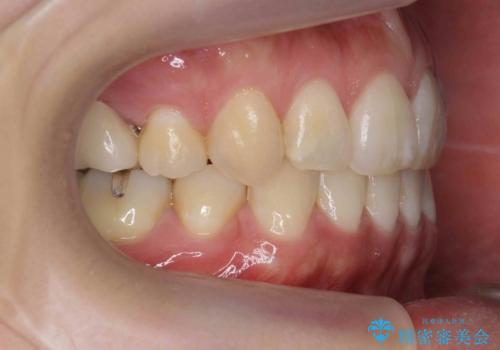 真ん中が右にずれている 前歯のがたつき 治療途中に地方へ引っ越したが、通ってワイヤー矯正の治療後