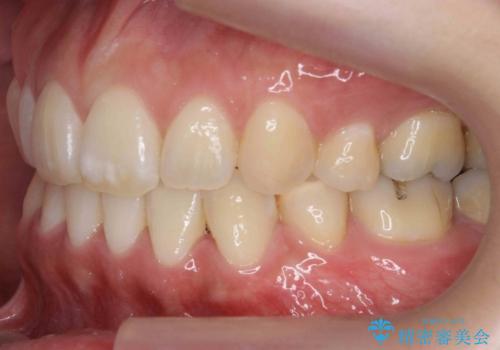 真ん中が右にずれている 前歯のがたつき 治療途中に地方へ引っ越したが、通ってワイヤー矯正の治療後