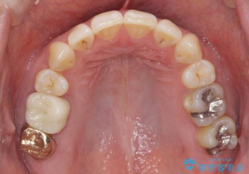 真ん中が右にずれている 前歯のがたつき 治療途中に地方へ引っ越したが、通ってワイヤー矯正の治療後