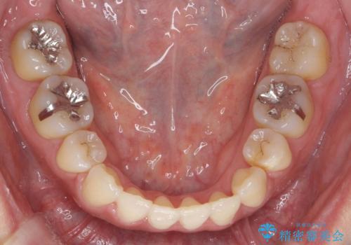 真ん中が右にずれている 前歯のがたつき 治療途中に地方へ引っ越したが、通ってワイヤー矯正の治療後