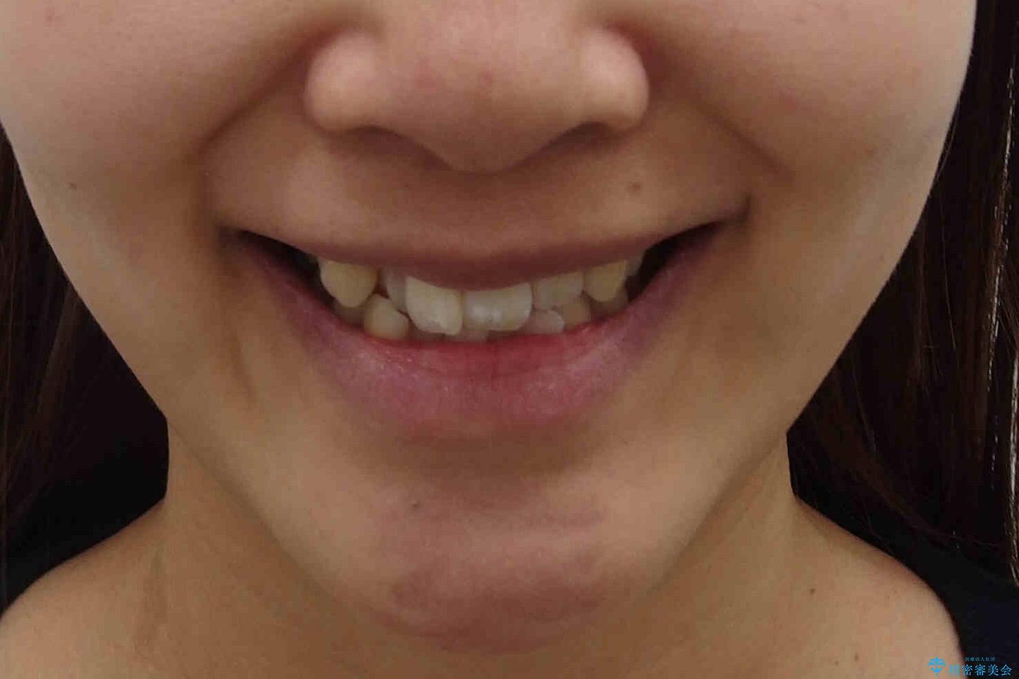 真ん中が右にずれている　前歯のがたつき　治療途中に地方へ引っ越したが、通ってワイヤー矯正の治療前（顔貌）