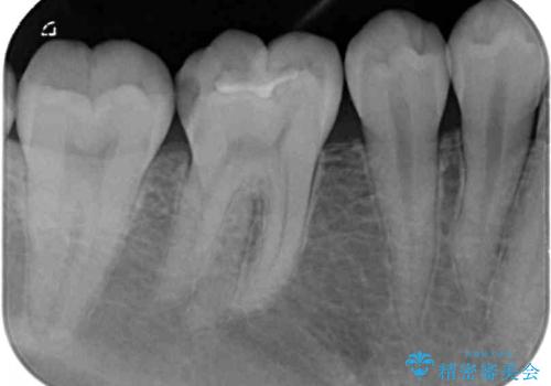 冷たいものがしみる 奥歯のセラミックインレーの治療前
