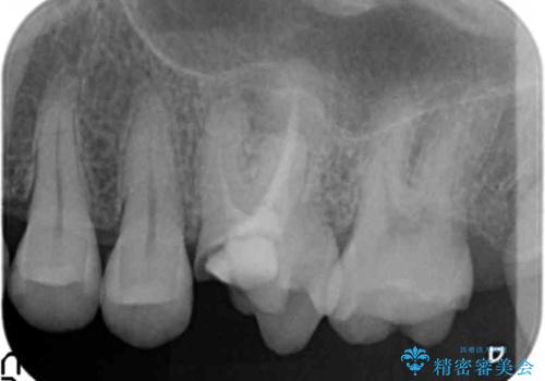 放置した虫歯 精密な治療の希望の治療前