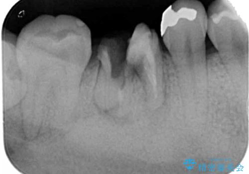 放置した虫歯 インプラントによる機能回復の治療前