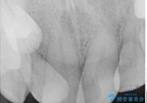 前歯が折れたついでに歯並びも改善 矯正治療と前歯のセラミック治療の治療前