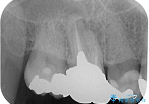 奥歯が痛い セラミッククラウンでの虫歯治療の治療前