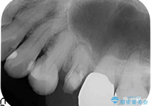 他院で抜歯と言われた 残したいの治療前