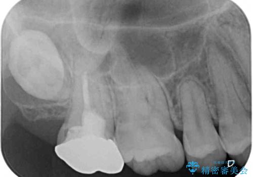 不快感が続く奥歯 外科処置を併用したセラミック補綴治療の治療前
