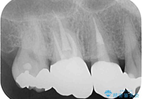 奥歯が痛い セラミッククラウンでの虫歯治療の治療後
