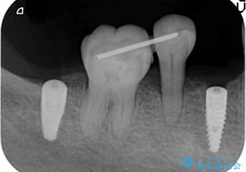 [ 臼歯部インプラント治療 ]   抜けた歯を治療したいの治療中