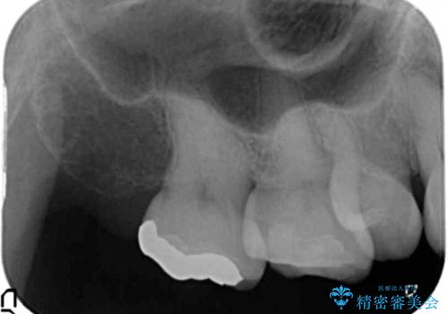奥歯の銀歯、プラスチックのやりかえの治療前