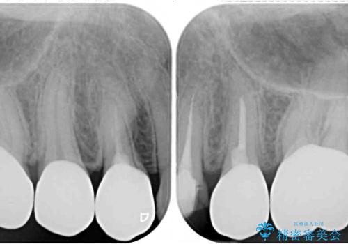 治療中放置してしまった奥歯 セラミック治療の治療後
