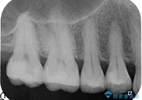銀歯を白く　虫歯治療の治療後