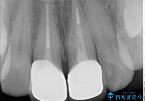 変色した前歯をセラミックでひっこめたい の治療後