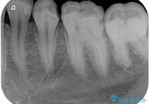 詰め物が欠けた セラミックインレーによる修復の治療前