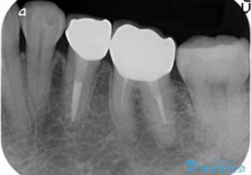 下の銀歯をセラミックに　虫歯治療の治療後