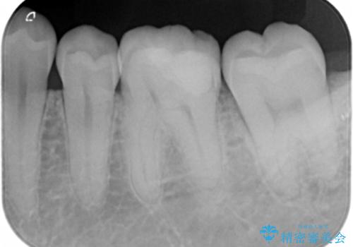 以前入れた詰め物が欠けたの治療前