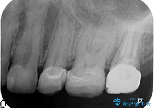 [ 2次カリエス ]クラウンのグラつき クラウン下の虫歯再発の治療前