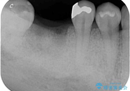 放置した虫歯 インプラントによる機能回復の治療中