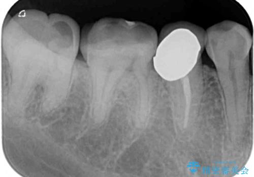 奥歯が欠けてしまった オールセラミッククラウンによる補綴治療の治療前