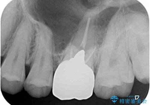 目立つ銀歯を白くしたい セラミック治療の治療前