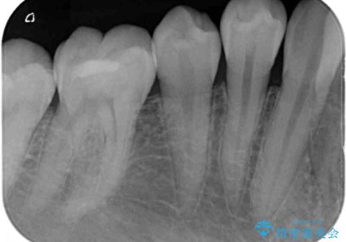 冷たいものがしみる 奥歯のセラミックインレーの治療後