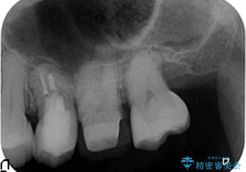 他院で抜歯と言われた 残したいの治療中