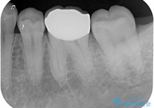 以前入れた詰め物が欠けたの治療後