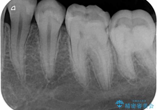 詰め物が欠けた セラミックインレーによる修復の治療後