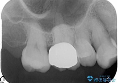 奥歯の銀歯、プラスチックのやりかえの治療後
