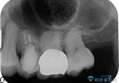 他院で抜歯と言われた 残したいの治療後